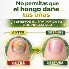 Dile Adiós a los Hongos en las Uñas con este Poderoso Remedio Natural de Laurel.