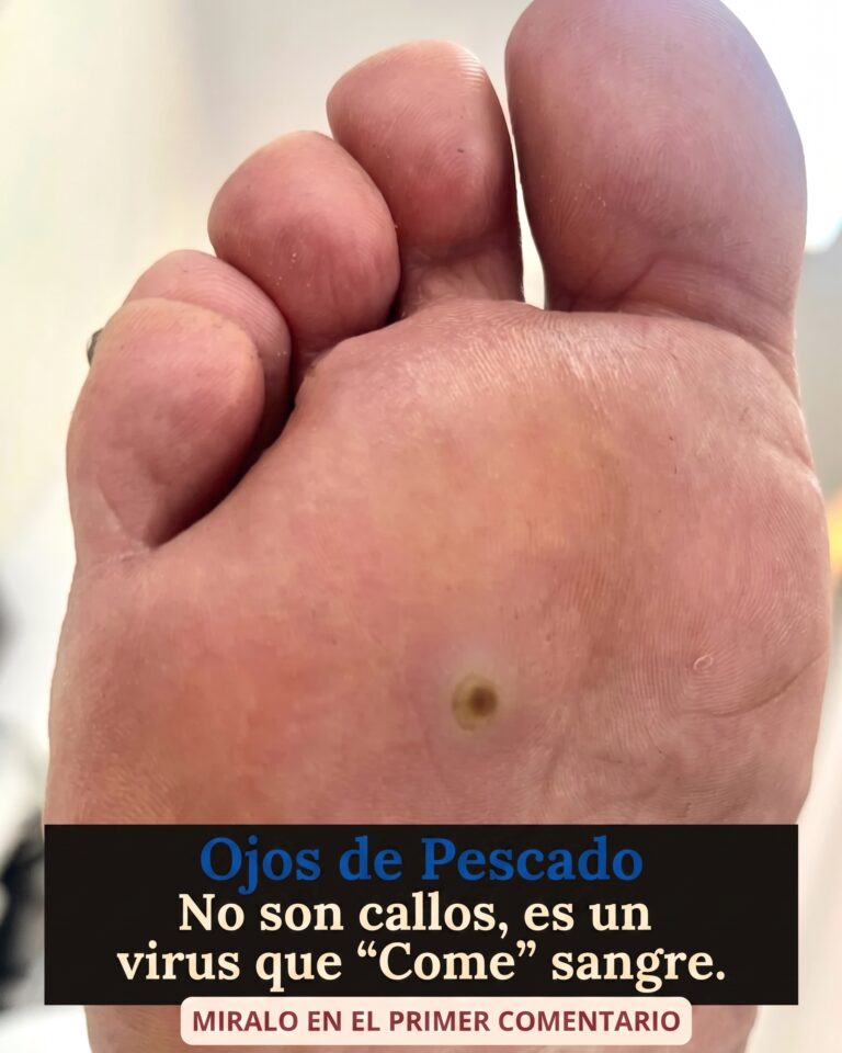 Ojo de Pescado: La Verruga Plantar que Muchos Confunden con un Callo y que Puede Volverse Muy Dolorosa